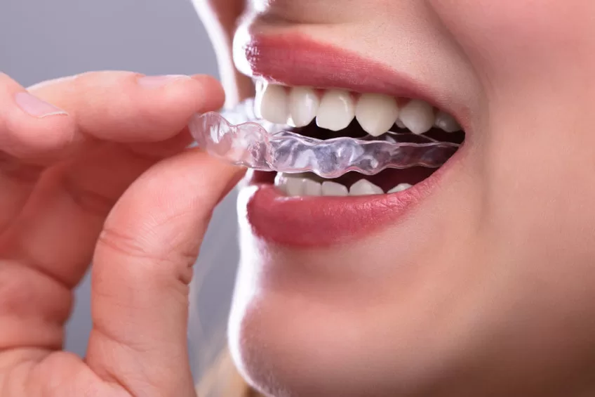 Woman Putting Transparent Aligner In Teeth Woman Putting Transparent Aligner In Teeth